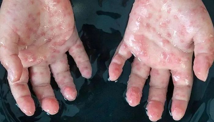 آبله میمونی چگونه منتقل می‌شود؟