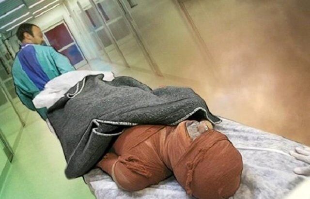 سالانه ۳۰۰ هزار نفر در ایران دچار سوختگی می‌شوند/ سوختگی در ایران ۸ برابر میانگین جهانی