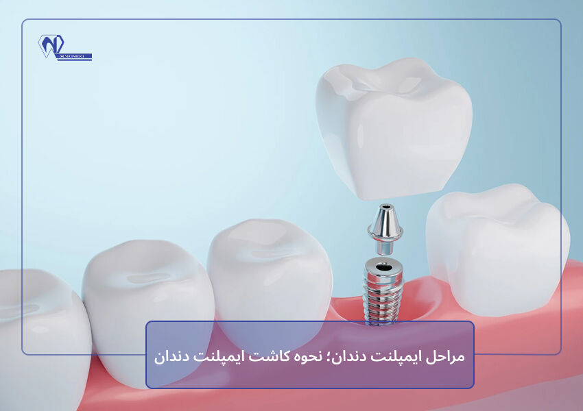 مراحل ایمپلنت دندان؛ نحوه کاشت ایمپلنت دندان
