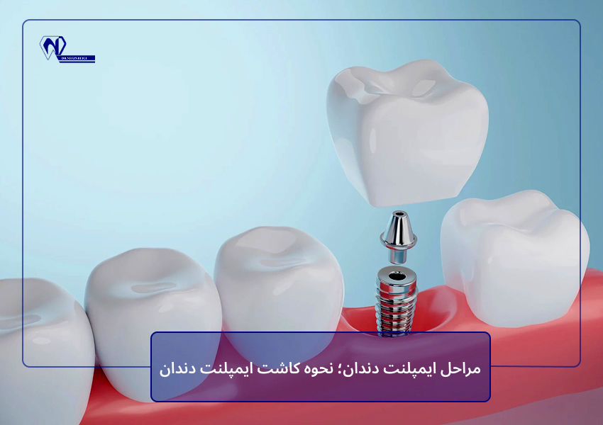 مراحل ایمپلنت دندان؛ نحوه کاشت ایمپلنت دندان
