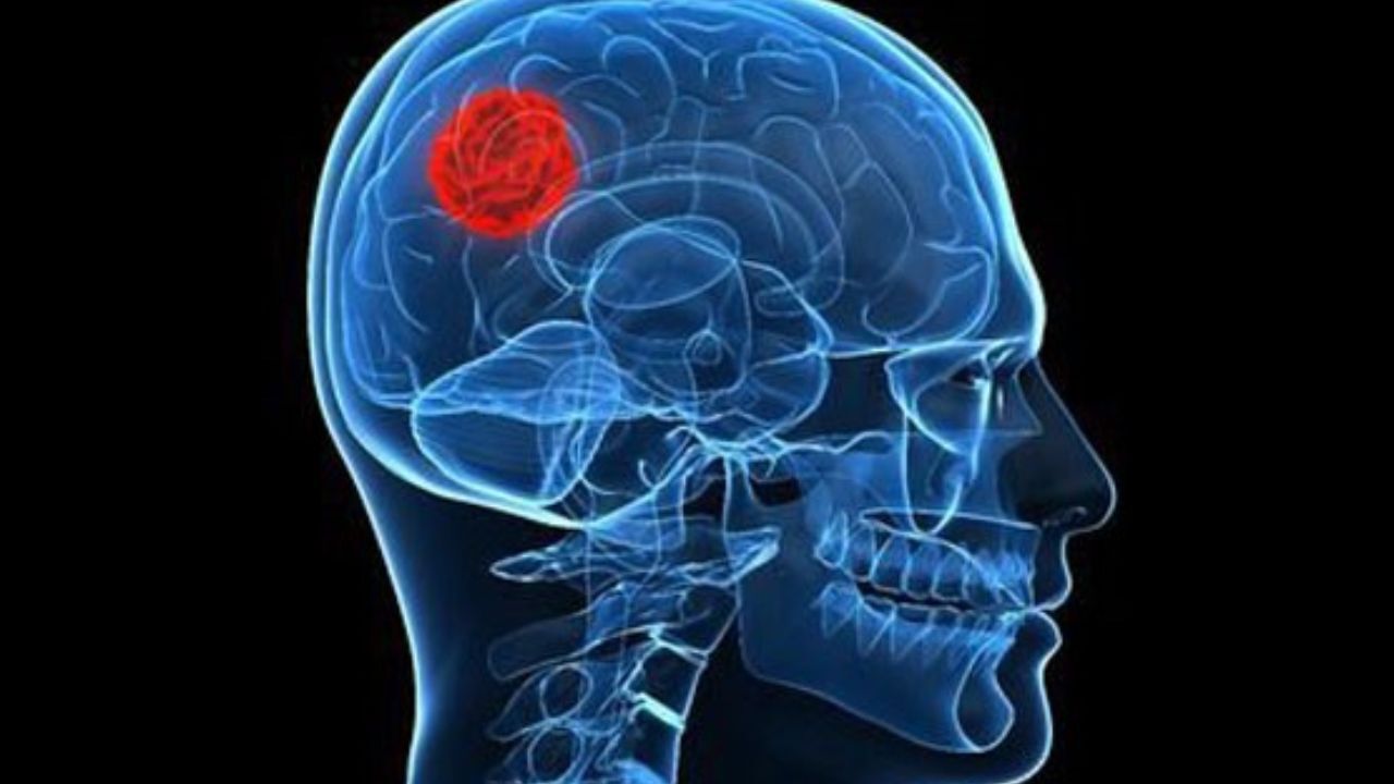 کنترل رشد تومورهای مغزی با تزریق ویروس