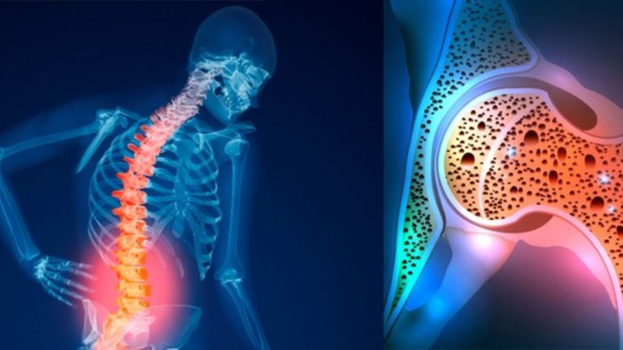 پوکی استخوان بیش از 40 درصد ایرانیان/گسترش بیماری‌های غیرواگیر به دنبال سبک زندگی نامناسب