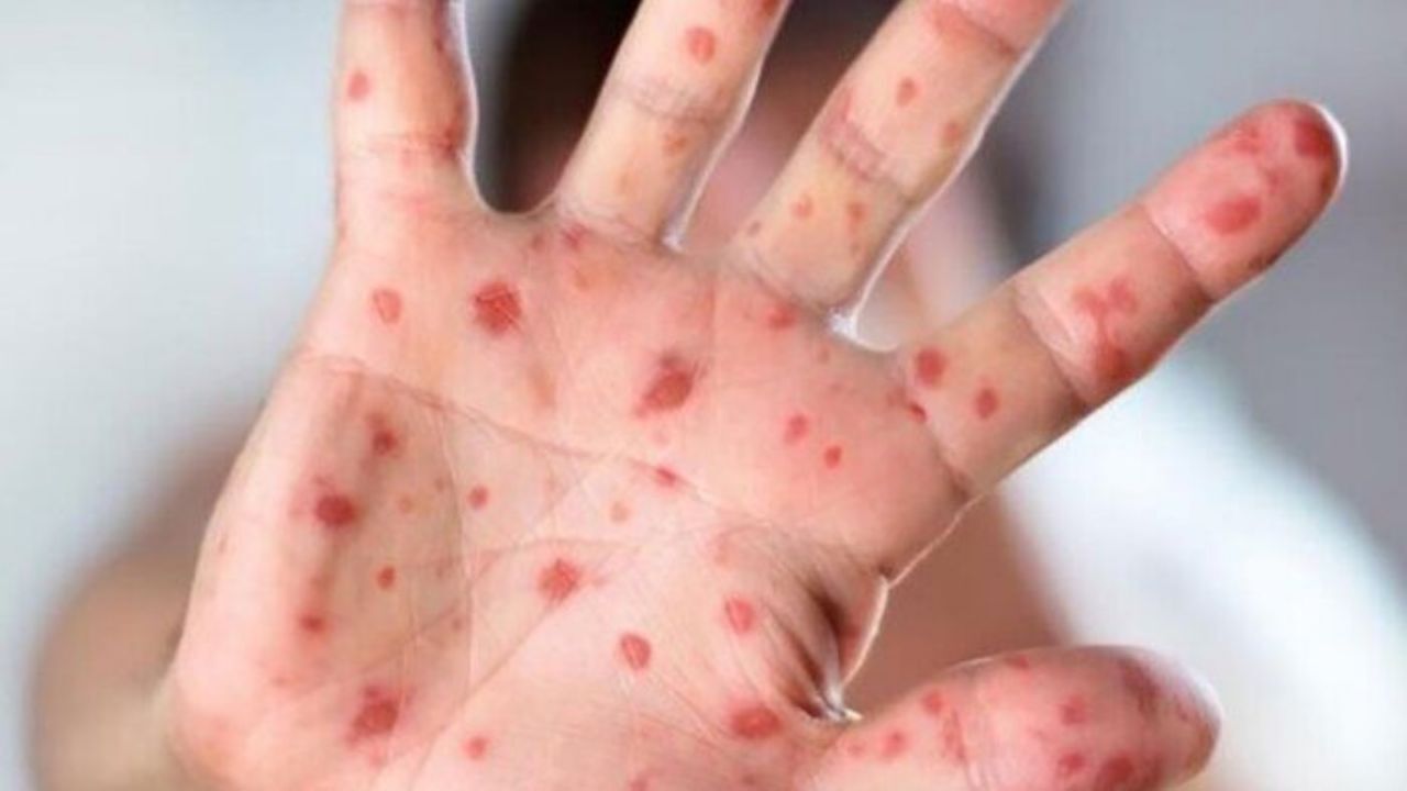2 مورد ابتلا به سرخک و یک مورد به سرخچه در قزوین شناسایی شده است