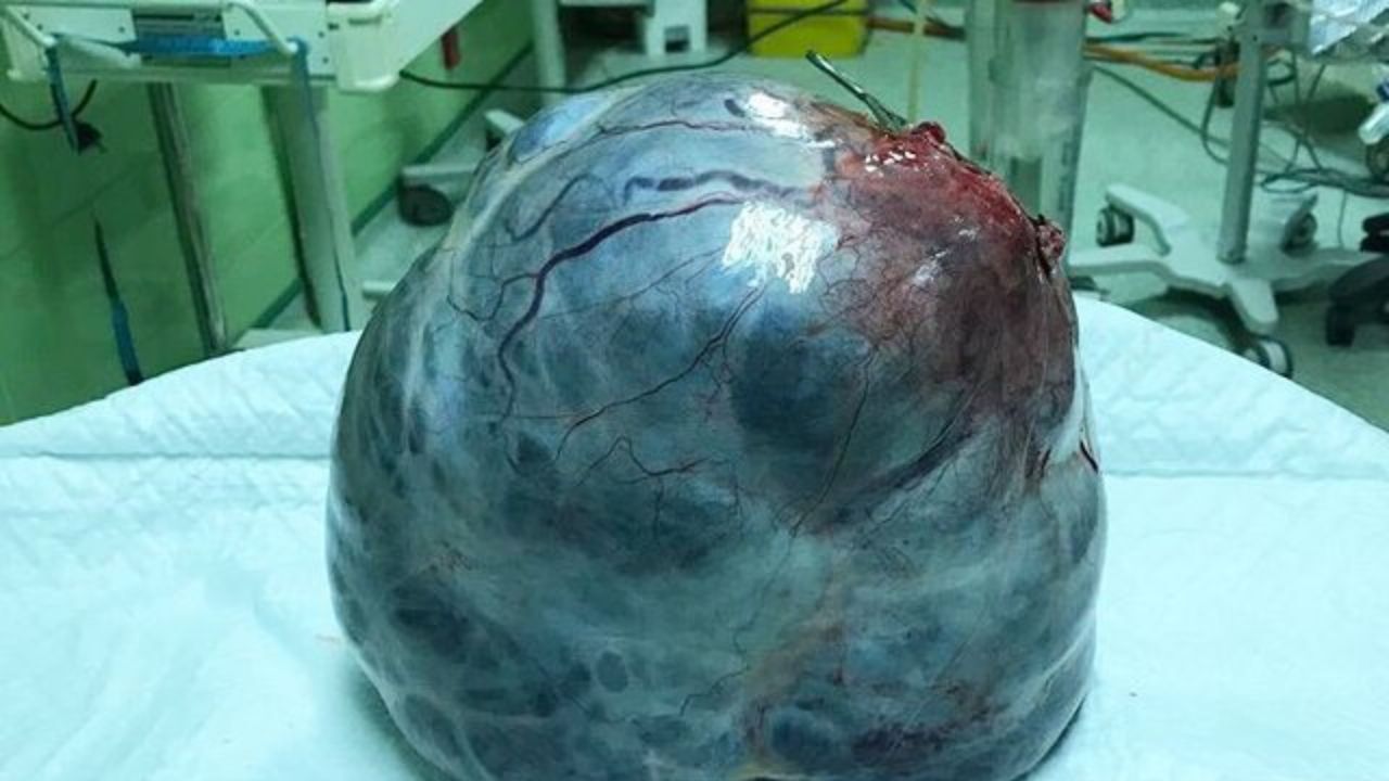 توده 6 کیلویی از شکم زن 47 ساله خارج شد