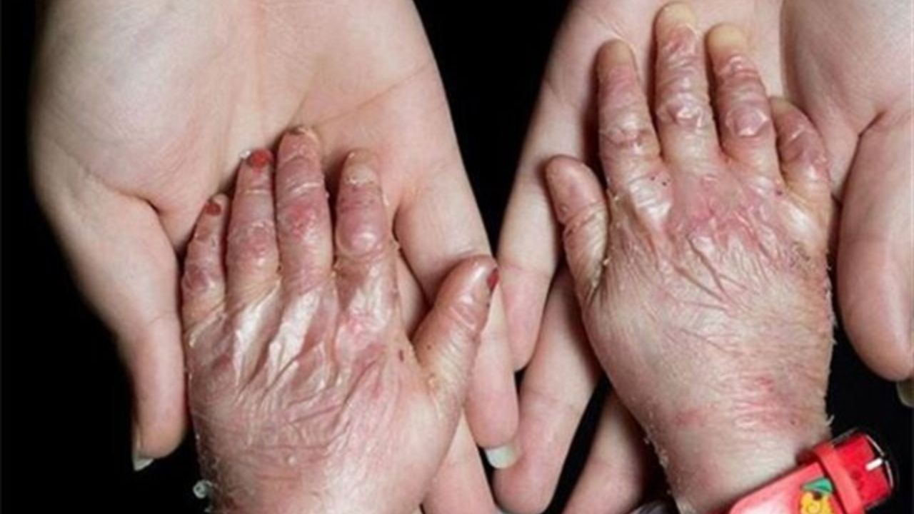سرنوشت پوشش بیمه‌ای پانسمان بیماران پروانه‌ای چه شد؟