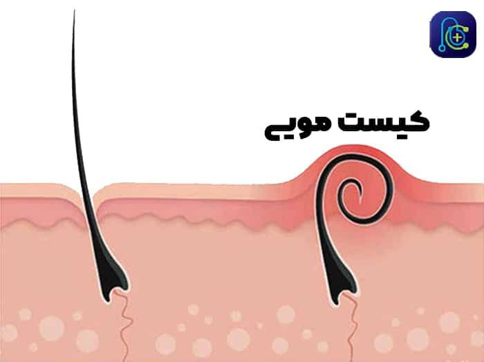 درمان کیست مویی مقعدی از جراحی تا لیزر