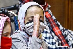 گزارش روزنامه اعتماد از رنج بیماران پروانه‌ای / در ایران هزار و ۳۵۰ بیمار پروانه‌ای شناسایی شده است