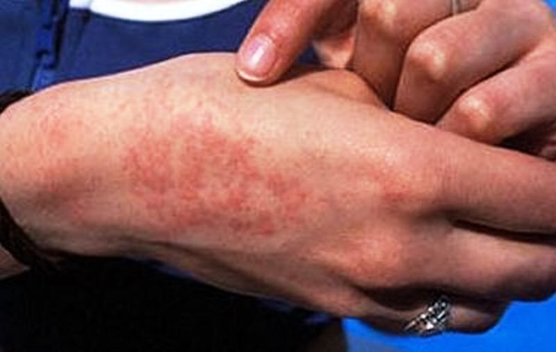 مراقب شیوع این بیماری خطرناک در بهار باشید